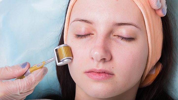 what-is-microneedling-722x406